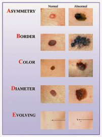 ABCDE of melanoma