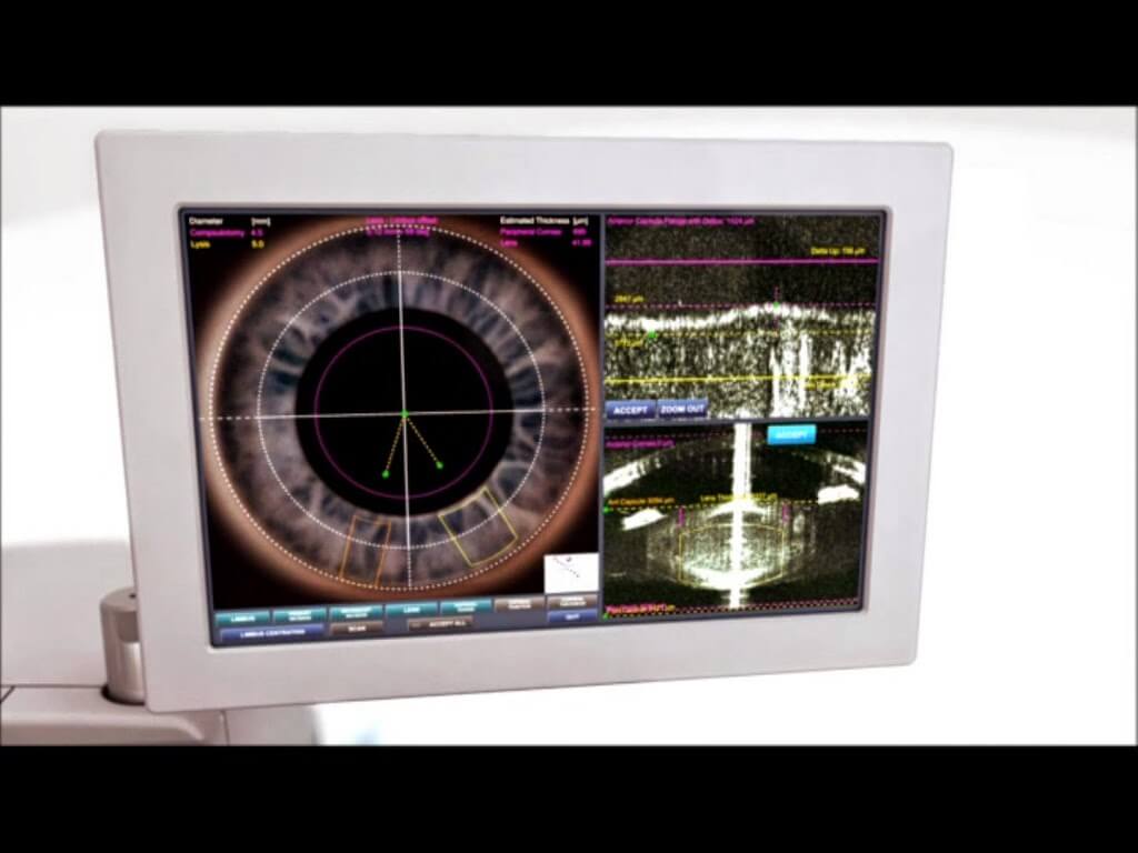 cataract-surgery-bladelss-laser-cararact-surgery-vs-traditional-the