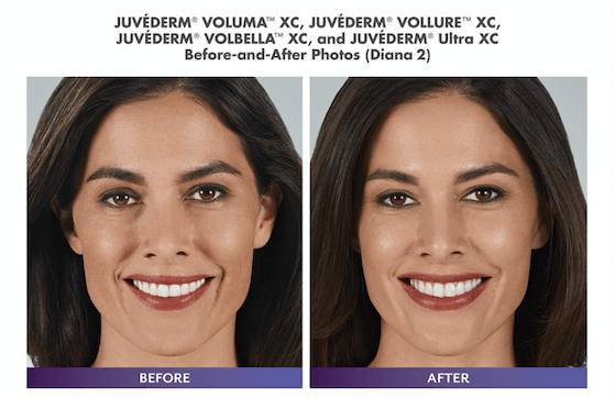 Before and after Juvederm