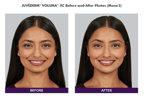 Before and after Juvederm