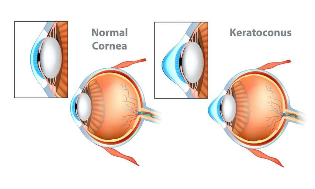 Diagram of Keratoconus